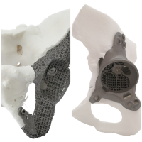 3D Additive Custom Implants 